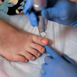 Nail Surgery